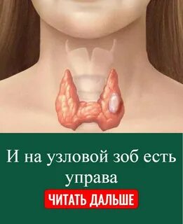 Многоузловой зоб 2 степени