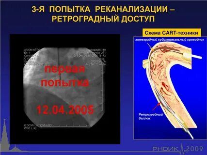 Реканализация это