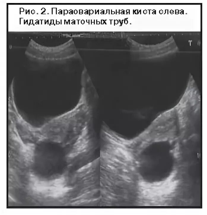 Надо ли удалять параовариальную кисту. Киста маточной трубы на УЗИ. Параовариальные кисты УЗИ. Гидатида маточной трубы на УЗИ.