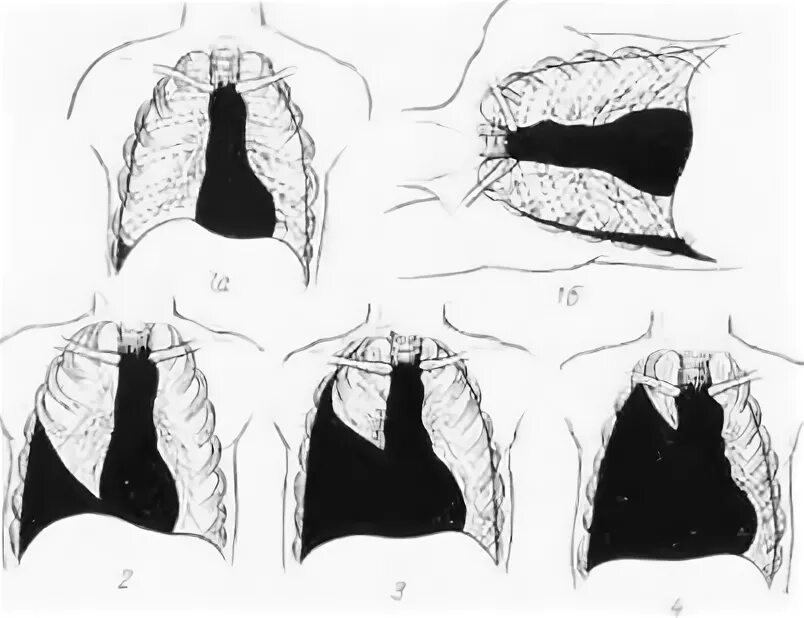 Пневмоторакс и гемоторакс. Схематически 3 степени гемоторакса..