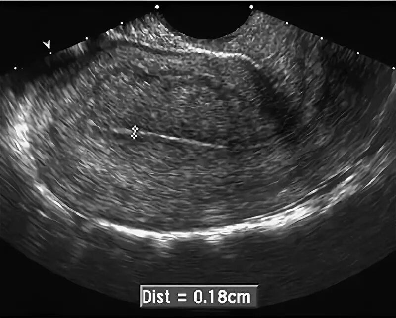 Синехия в полости матки на УЗИ. Синехии эндометрий на УЗИ. Синехии в полости матки на УЗИ. Гиперэхогенный полип эндометрия. Полость в эндометрии