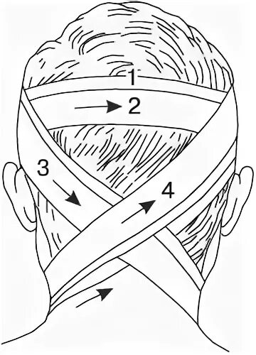 Крестообразная на затылок. Восьмиобразная повязка на затылок и шею. Технику наложения восьмиобразной повязки на затылок. Крестообразная повязка на затылок показания. Крестообразная повязка на затылок алгоритм.