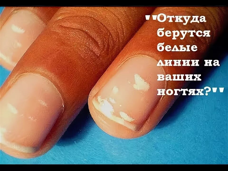 Белые круги на ногтях. Лейконихия белые пятна на ногтях. Лейконихия продольная. Лейконихия (белые пятнышки)
