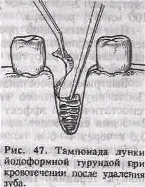 После удаления зуба через сколько убирать тампон