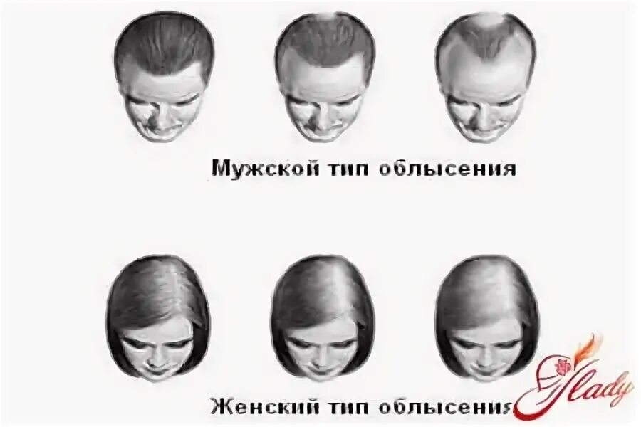 Типы облысения у женщин. Типы облысения у женщин