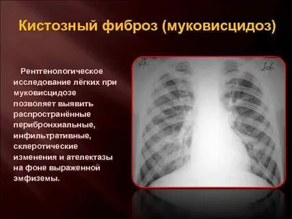Какой фиброз легких