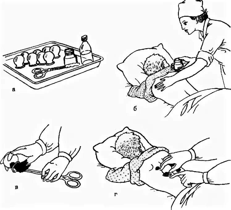 Действие банок. Постановка медицинских банок горчичников согревающего компресса. Постановка банок алгоритм. Постановка банок оснащение. Схема постановки медицинских банок.