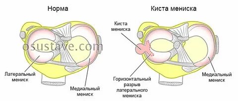 Мениск коленного сустава последствия