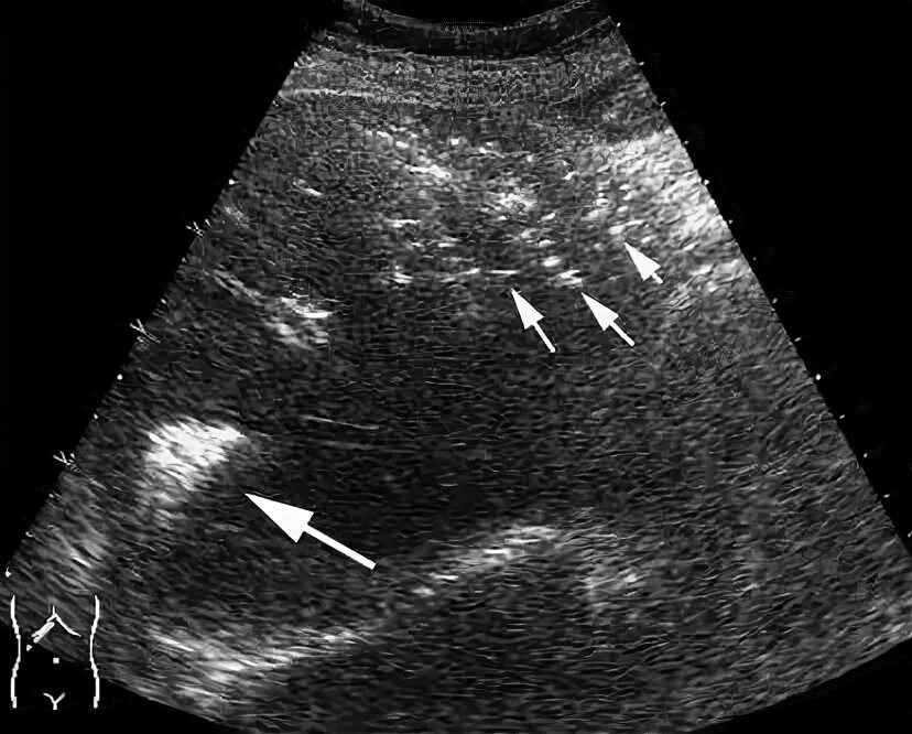 Гиперэхогенные включения в желчном пузыре. Гиперэхогенное образование в печени на УЗИ что это такое. Аэробилия желчных протоков. Гиперэхогенные структуры на УЗИ печени. Гиперэхогенные образования в печени на УЗИ.