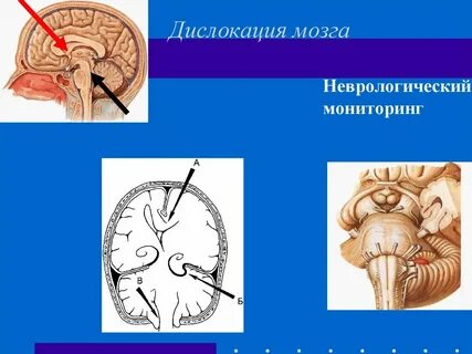 Дислокация мозга