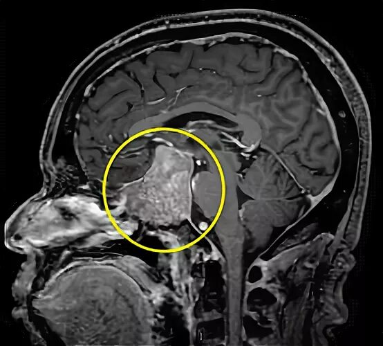Мрт мозга опасно. Мрт гипофиза с контрастом. Киста гипофиза головного мозга фото. Для эндокринолога мрт гипофиза.