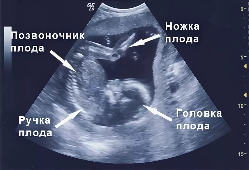 Как выглядеть беременности 19 недель. УЗИ плода на 19 неделе беременности. 19 Недель беременности фото плода на УЗИ. Фото УЗИ 19-20 недель беременности. Размер плода на 19 неделе беременности УЗИ.