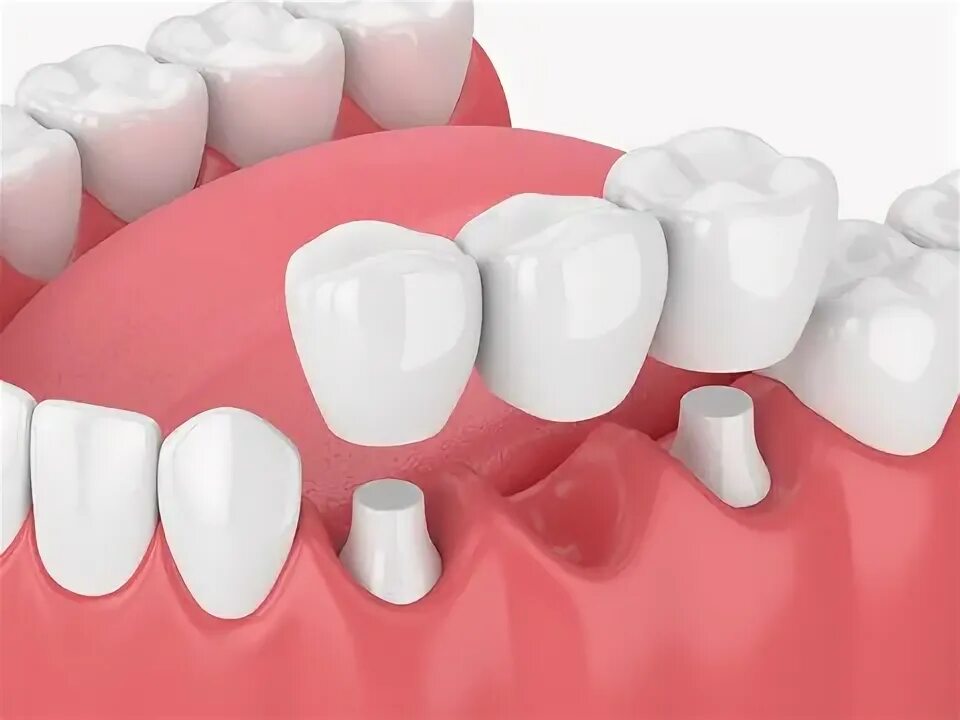 Как самому снять зубной мост Dental Bridges Melrose MA Restorative Dentistry Call Now in 2024 Dental bridge,