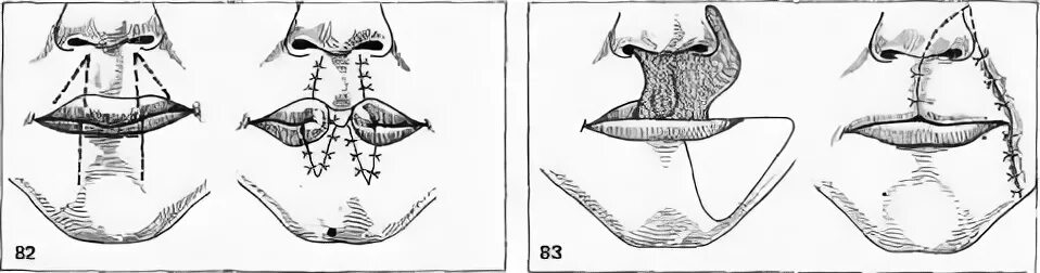 Операция нижней губы. Пластика нижней губы по Брунсу. Операция на губе по Брунсу. Филатовский стебель ринопластика. Пластика нижней губы по Аббе.