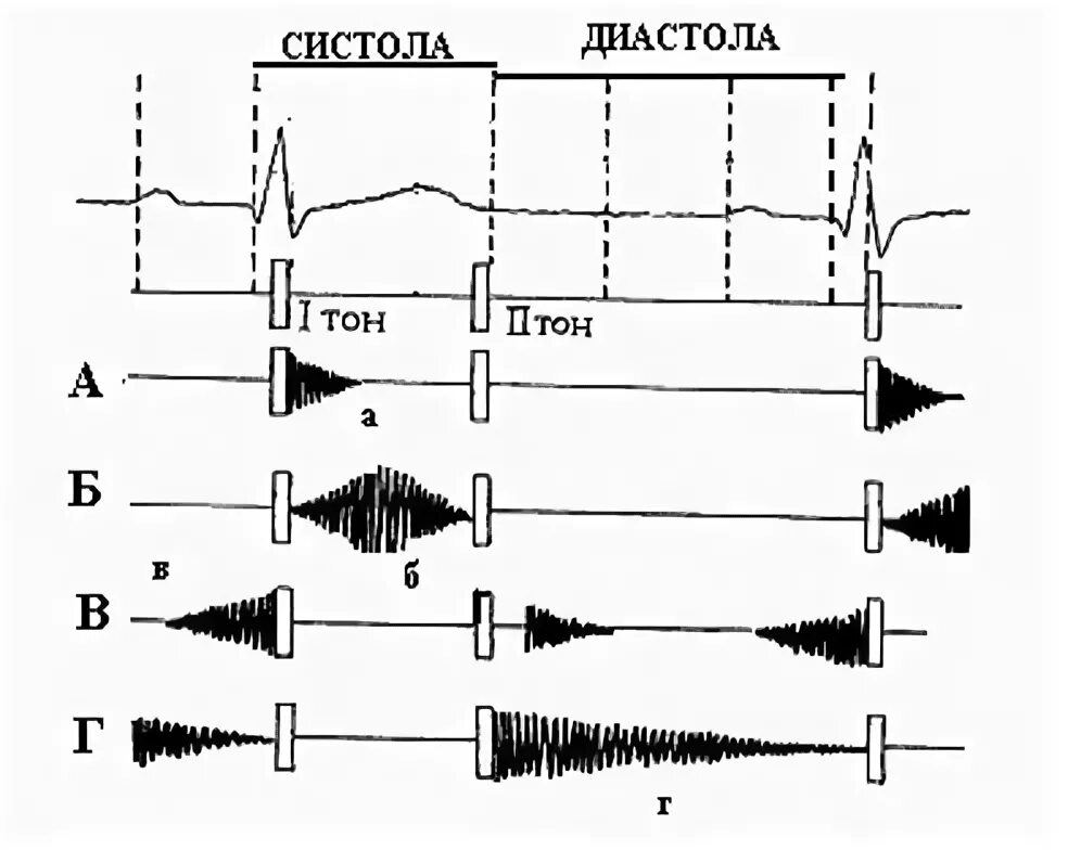 Схема ФКГ 2 тона. Сердечные тоны и шумы. Соотношение тонов и шумов сердца. Внутрисердечные шумы соотношение тонов и шумов. Сердечные тоны шумы