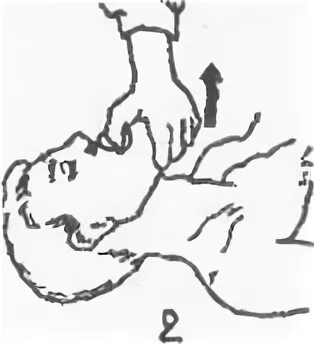 Двухсторонний захват нижней челюсти. Восстановление проходимости ВДП. Захват челюсти