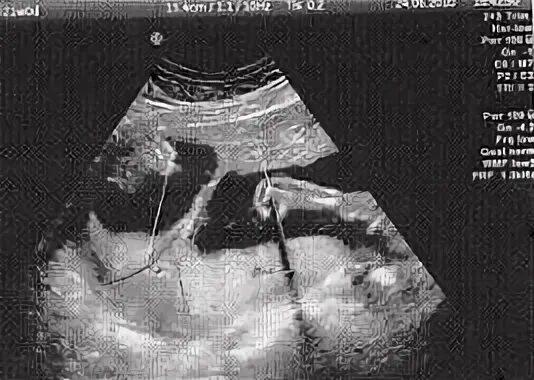 Фото имплантационного периода гинекологическое. Рдв полости матки