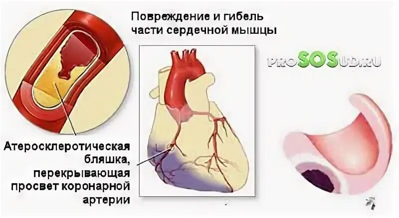 Лечение сердечной Жабы. Трабекулярные мышцы сердца.