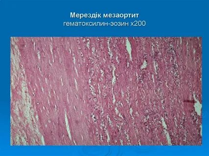 Сифилитический мезаортит