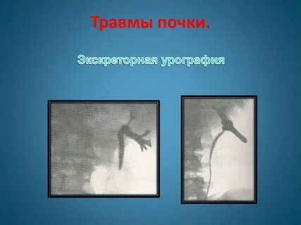 Ушибленные почки