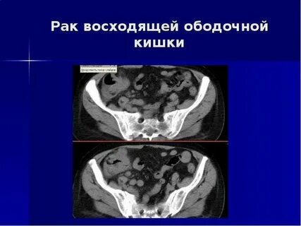 Новообразования поперечно ободочной кишки