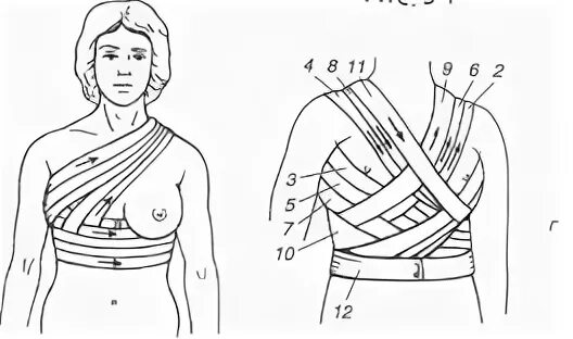 Повязка на молочные железы алгоритм. Поддерживающая повязка на молочную железу алгоритм. Наложение поддерживающей повязки на молочную железу. Бинтовая повязка на молочную железу. Наложить повязку на молочную железу алгоритм.