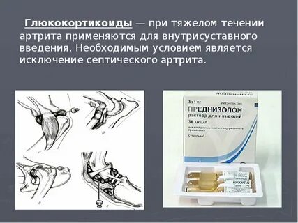 Внутрисуставные гкс