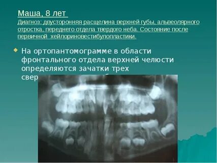 Отсутствие зачатка