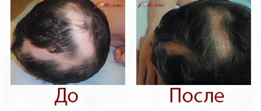 Плазмотерапия волос до и после фото Услуги по удалению папиллом в Шиховом: 6 исполнителей с отзывами и ценами на Янд