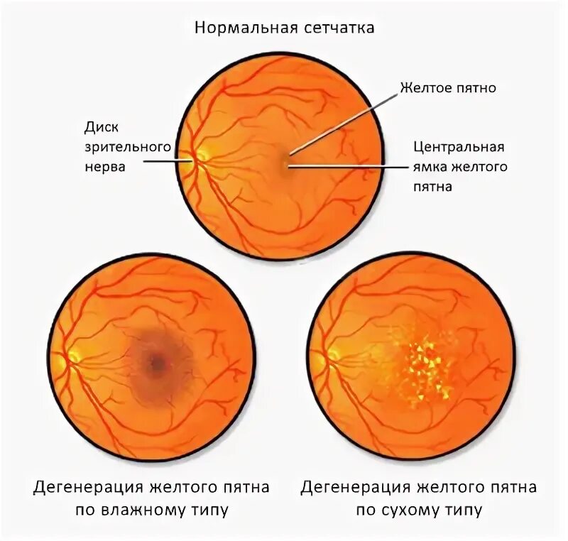 Ангиопатия сетчатки код