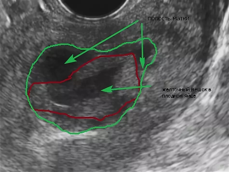 видит ли узи спайки