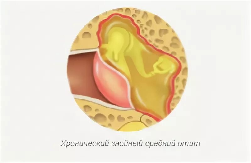 Хронический тубоотит