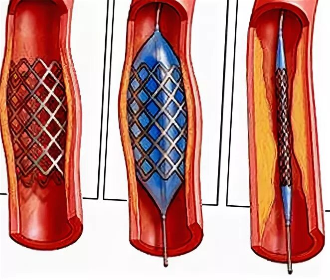 Болит стент. Ангиопластика сосудов нижних конечностей. Баллонная ангиопластика артерий нижних конечностей ход операции. Стентирование сосудов нижних конечностей. Стентирование сосудов сердца.