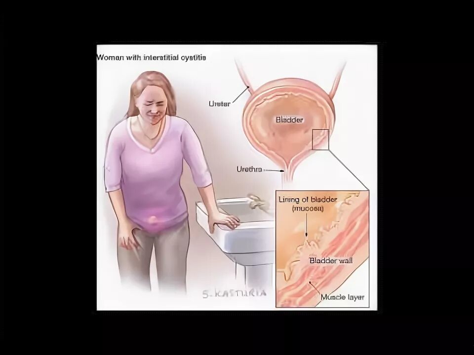 Боли внизу мочевого пузыря у женщин. Цистит клиническая картина. Клинические проявления цистита. Рези в мочеиспускательном канале у женщин причины. Клинические симптомы цистита.