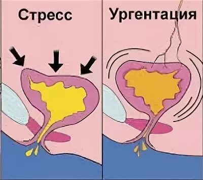 Пролапс недержание мочи