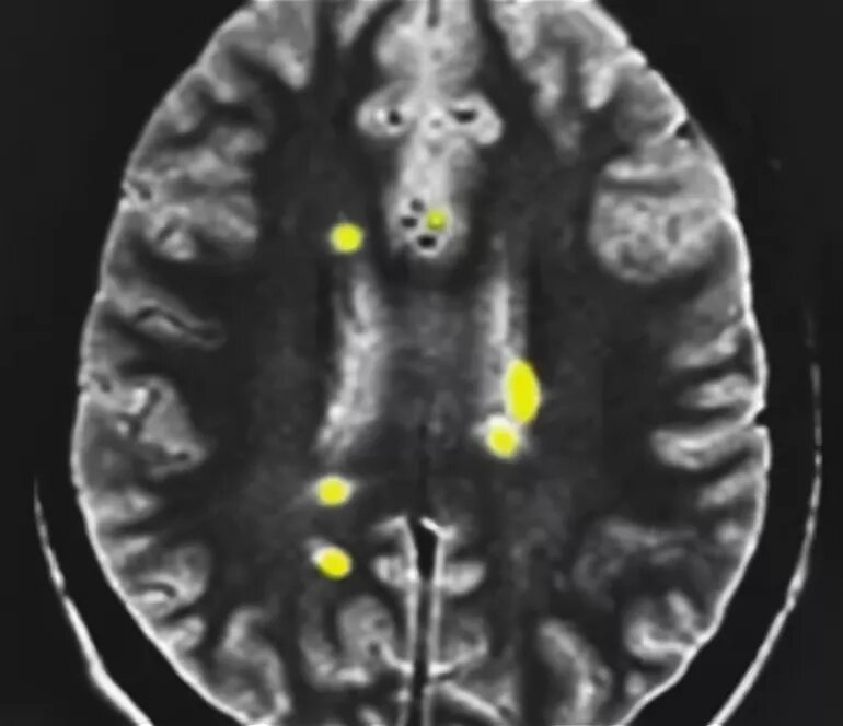 Демиелинизация головного мозга мрт. Мрт мозга при рассеянном склерозе. Симптом пальцев Доусона. Очаги демиелинизации головного мозга что это такое. Многоочаговое поражение головного мозга