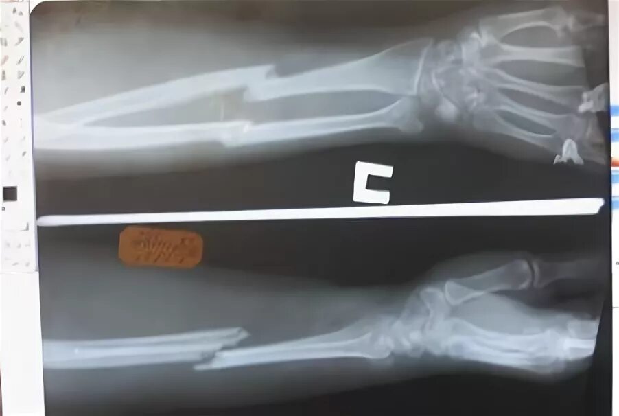 перелом лучевой кости рентген. закрытый перелом руки со смещением. закрытый перелом руки со смещением. перелом лучевой кости и локтевой кости со смещением. перелом лучевой кости со смещением рентген.