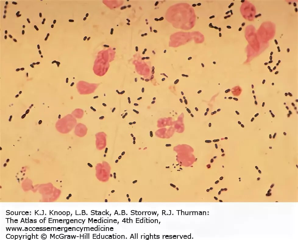 Staphylococcus в мазке у женщин. Кокки диплококки внеклеточные. диплококки в гинекологическом мазке. диплококки женский мазок. кокковая флора в женском мазке.