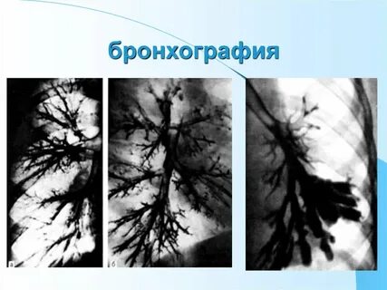 Бронхография