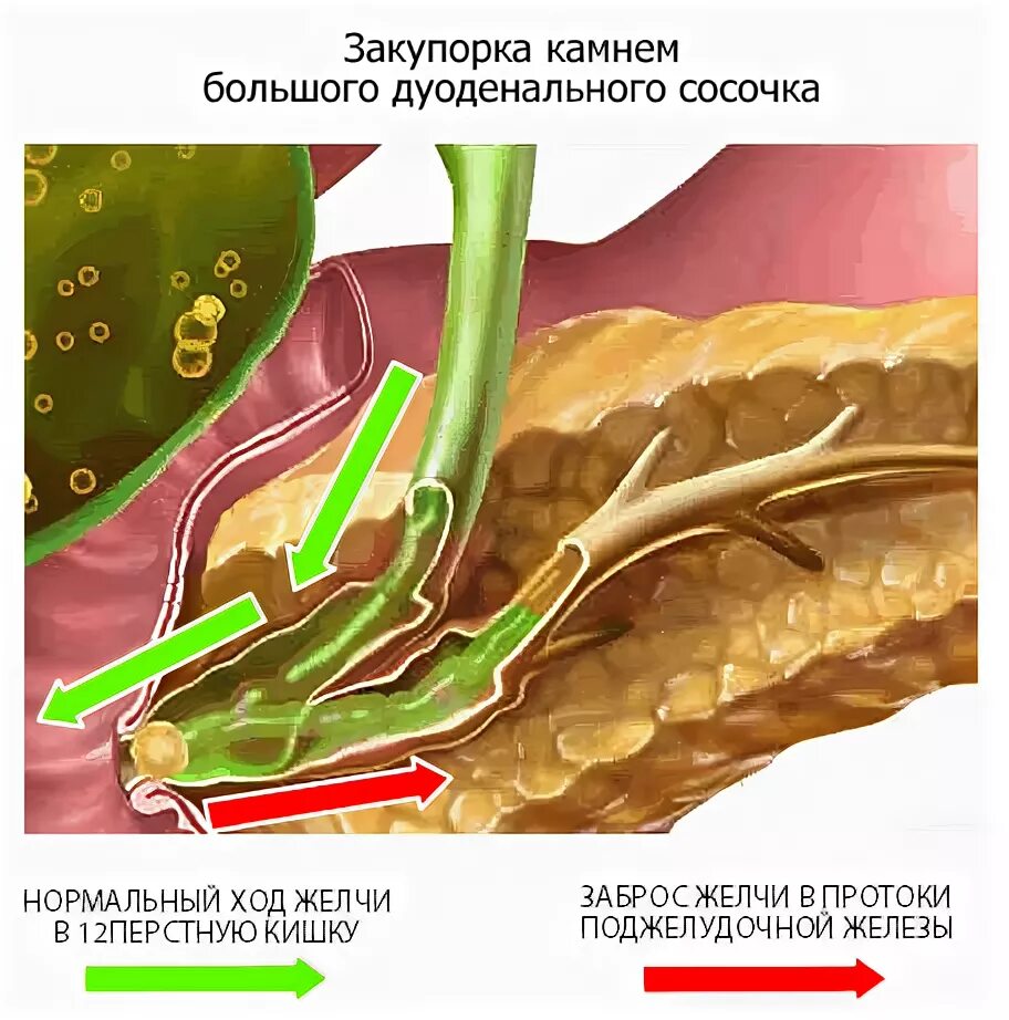 Билиарный панкреатит лечение