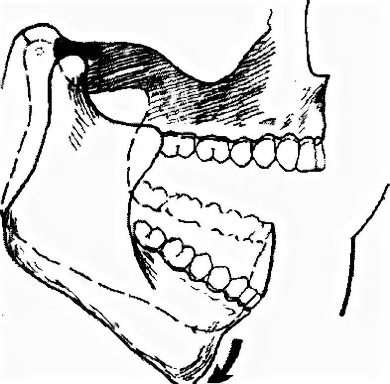 Биомеханика нижней челюсти ортопедия. ВНЧС биомеханика нижней челюсти. Клиническая биомеханика нижней челюсти. Мыщелок челюсти