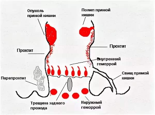 Заболевания прямой кишки проктит. Воспаление прямой кишки. Боли при воспалении прямой кишки. Воспаление слизистых прямой кишки. Боли внутри заднего прохода