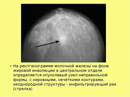 Плотный узел молочной железы
