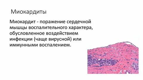 Миокардит после