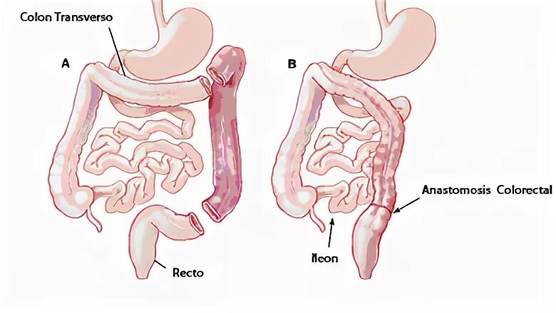Субтотальная резекция толстой кишки. Субтотальная колэктомия операция. Правосторонняя гемиколэктомия. Субтотальная резекция ободочной кишки с одноствольной илеостомией. Колэктомия это
