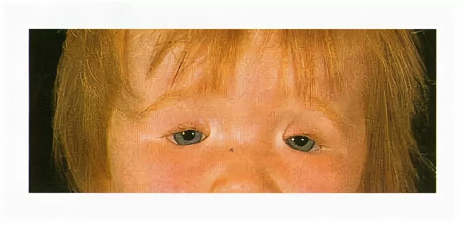 Узкая глазная щель. Укорочение глазной щели. Туранская раса признаки фото. Блефарофимоз наследственность. Широкая переносица у новорожденного.