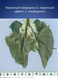 Первичный туберкулезный аффект