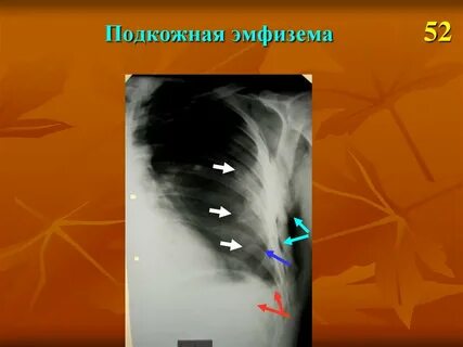 Эмфизема в стоматологии