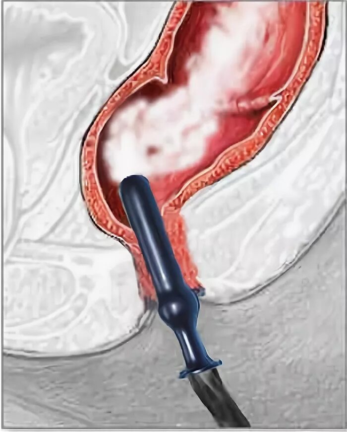 бужирование прямой кишки