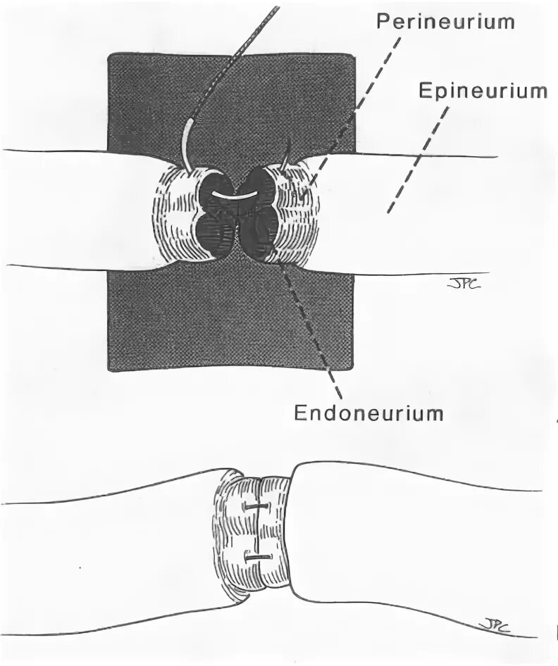 Сшивание нерва латынь. Эпиневральный шов нерва. Способы сближения концов нерва без натяжения. Сшивание нерва операция.